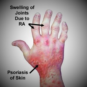 psoriatic arthritis