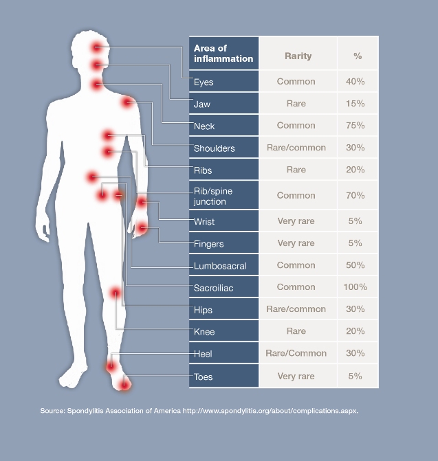 Ankylosing Spondylitis Chart