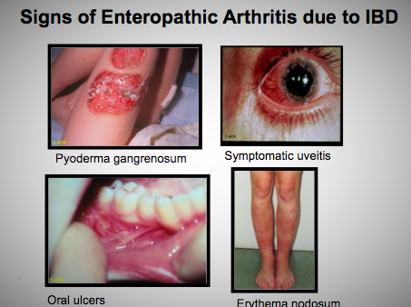Enteropathic Arthritis