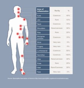 Ankylosing Spondylitis